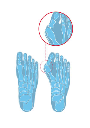 wandelnieuws hanwag bunion anatomie
